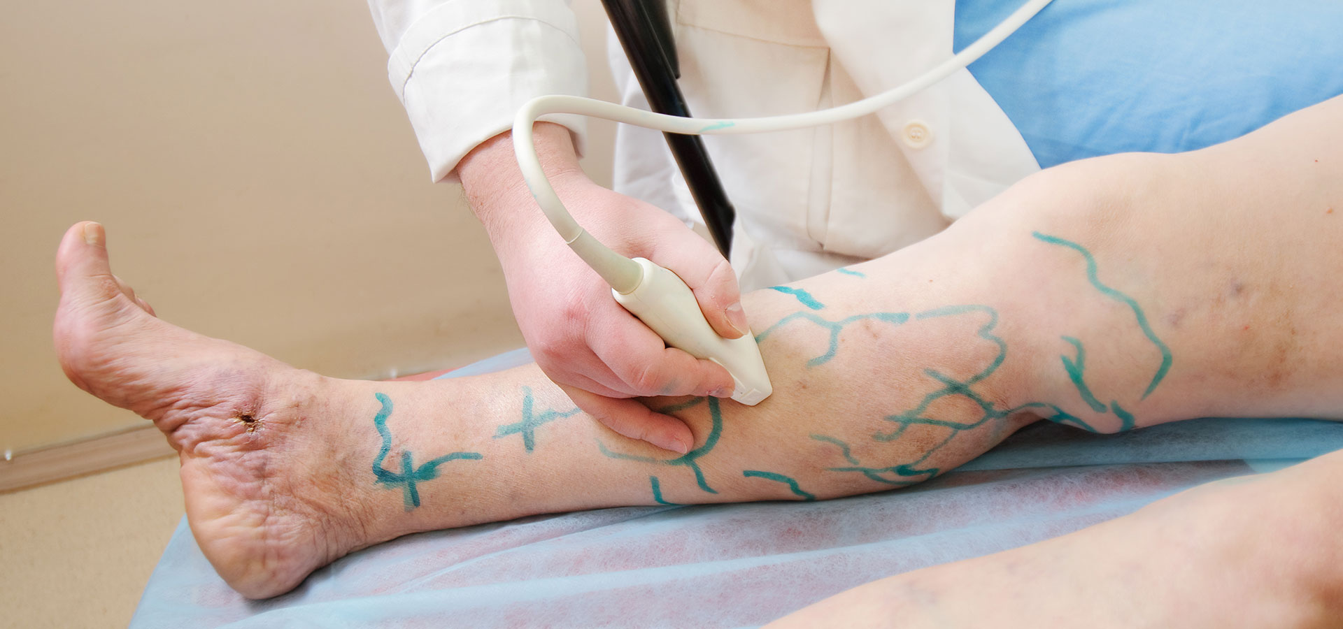 Can Varicose Veins Cause Skin Discoloration?: Center for Varicose